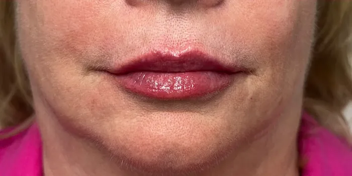 After Lip Filler before and after at Florida Aesthetics and Wellness in Brandon, FL