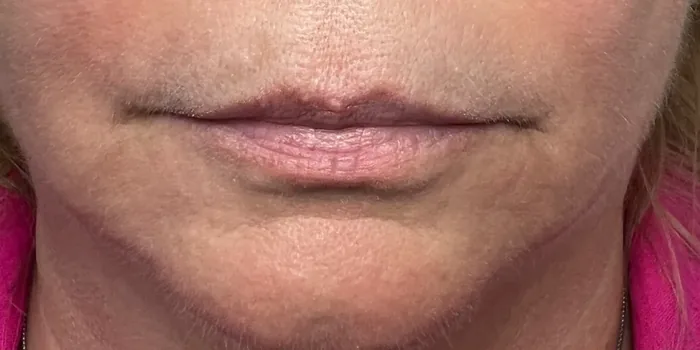 Before Lip Filler before and after at Florida Aesthetics and Wellness in Brandon, FL