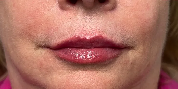 After Lip Filler before and after at Florida Aesthetics and Wellness in Brandon, FL