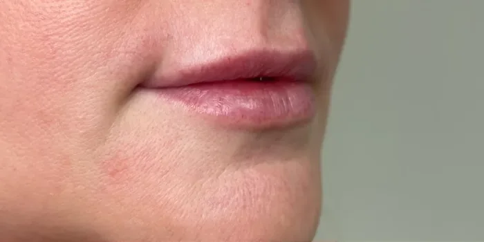Before Lip Filler before and after at Florida Aesthetics and Wellness in Brandon, FL