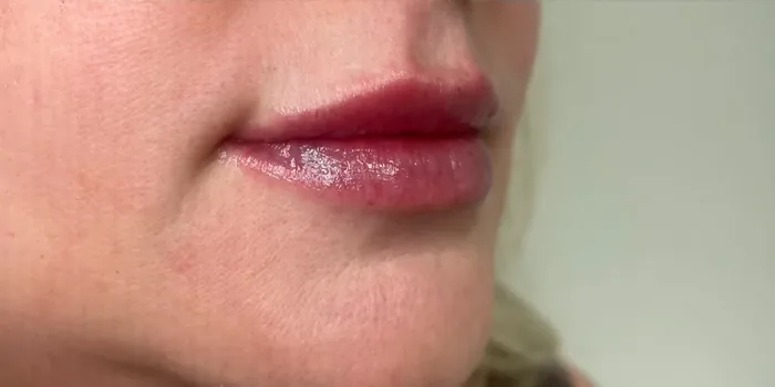 After Lip Filler before and after at Florida Aesthetics and Wellness in Brandon, FL