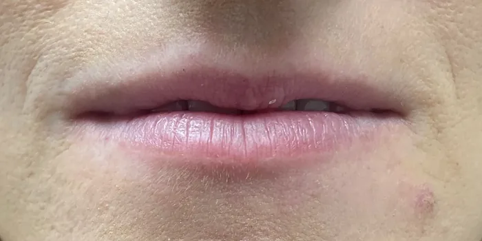 Before Lip Filler before and after at Florida Aesthetics and Wellness in Brandon, FL