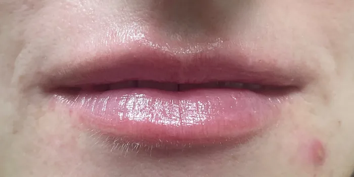 After Lip Filler before and after at Florida Aesthetics and Wellness in Brandon, FL