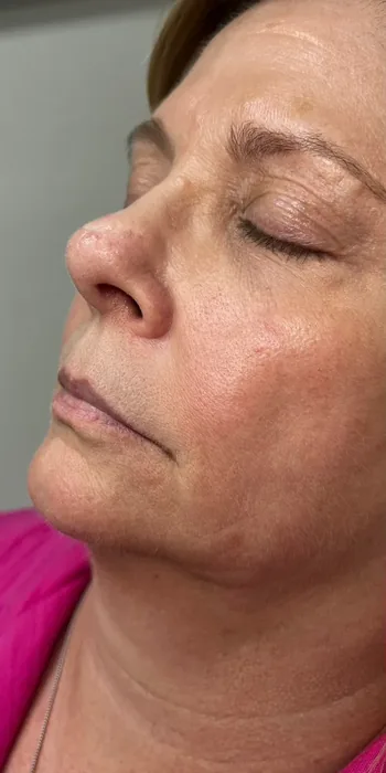 Before Lip Filler before and after at Florida Aesthetics and Wellness in Brandon, FL