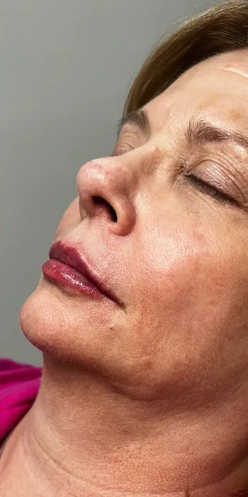 After Lip Filler before and after at Florida Aesthetics and Wellness in Brandon, FL