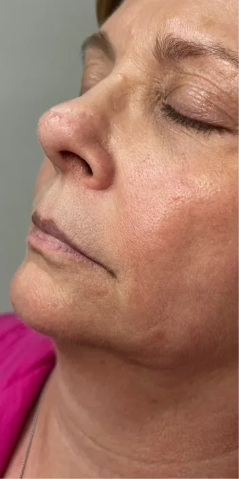 Before Lip Filler before and after at Florida Aesthetics and Wellness in Brandon, FL