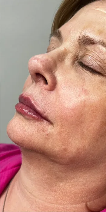 After Lip Filler before and after at Florida Aesthetics and Wellness in Brandon, FL