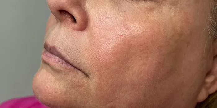 Before Lip Filler before and after at Florida Aesthetics and Wellness in Brandon, FL