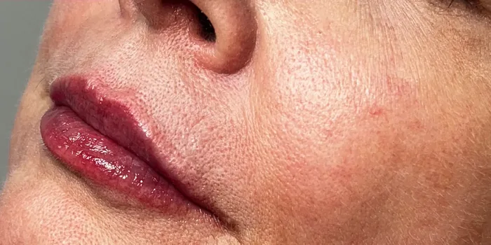 After Lip Filler before and after at Florida Aesthetics and Wellness in Brandon, FL