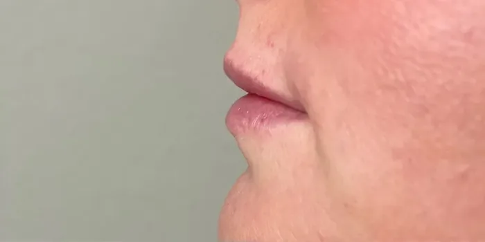 Before Lip Filler before and after at Florida Aesthetics and Wellness in Brandon, FL