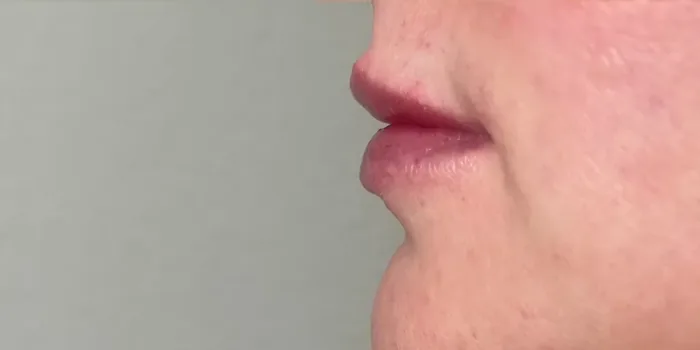 After Lip Filler before and after at Florida Aesthetics and Wellness in Brandon, FL