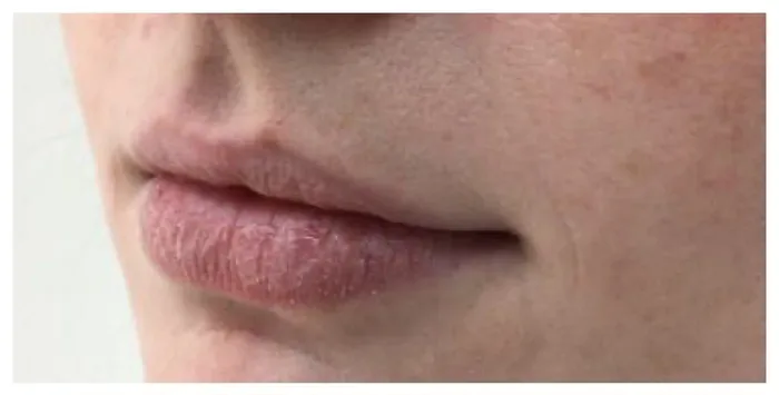 Before Lip Filler before and after at Florida Aesthetics and Wellness in Brandon, FL