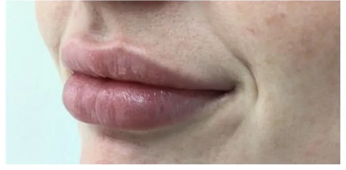 After Lip Filler before and after at Florida Aesthetics and Wellness in Brandon, FL
