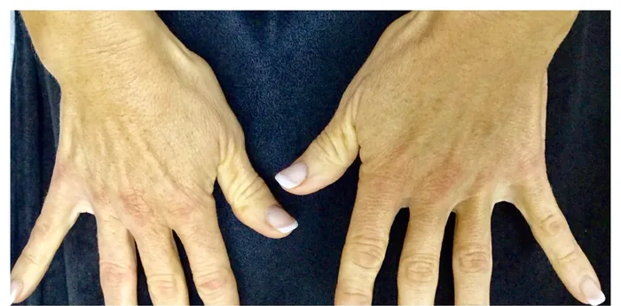 Before Hands Rejuvenation with Radiesse before and after at Florida Aesthetics and Wellness in Brandon, FL