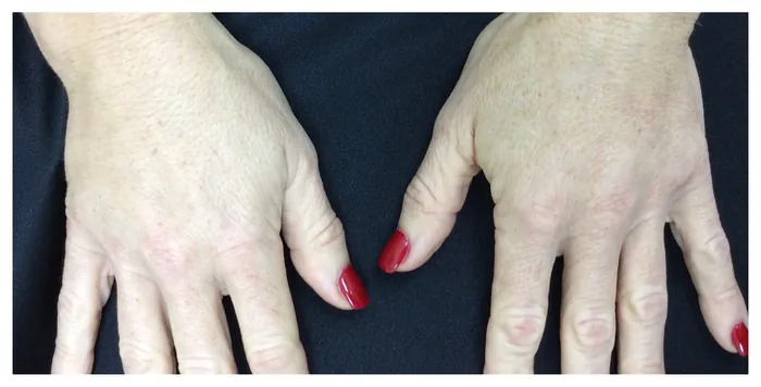 After Hands Rejuvenation with Radiesse before and after at Florida Aesthetics and Wellness in Brandon, FL