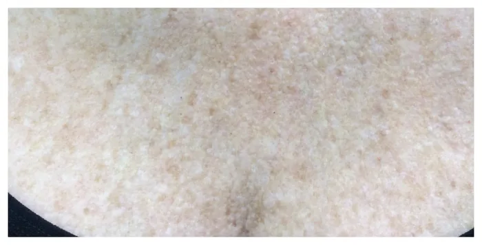 Chest after Radiesse décolleté treatment at Florida Aesthetics and Wellness in Brandon, FL