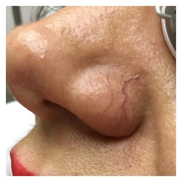 Before Spider Veins before and after at Florida Aesthetics and Wellness in Brandon, FL
