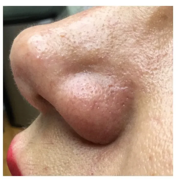 After Spider Veins before and after at Florida Aesthetics and Wellness in Brandon, FL