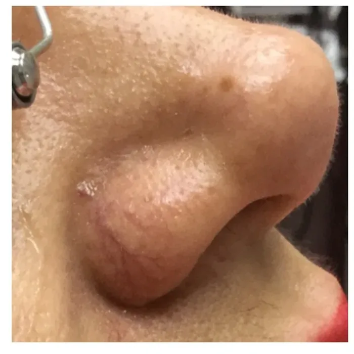 Before Spider Veins before and after at Florida Aesthetics and Wellness in Brandon, FL