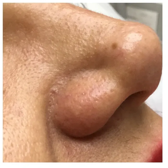 After Spider Veins before and after at Florida Aesthetics and Wellness in Brandon, FL