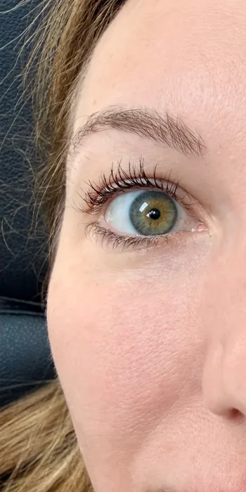 After Temple Filler before and after at Florida Aesthetics and Wellness in Brandon, FL