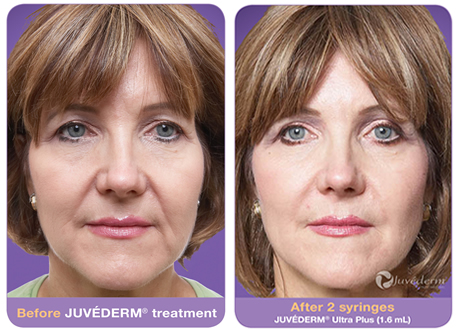 Juvederm lip injections in Tampa The cost of Juvederm treatment