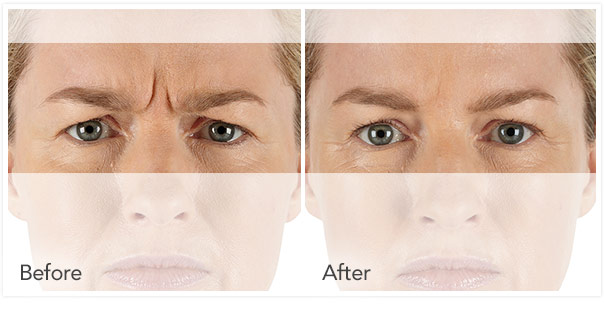Xeomin anti-aging injectable by Board-certified injectors at Florida Aesthetics and Medical Weight Loss in Tampa and Brandon, FL Xeomin anti-aging injectable by Board-certified injectors at Florida Aesthetics and Medical Weight Loss in Tampa and Brandon, FL