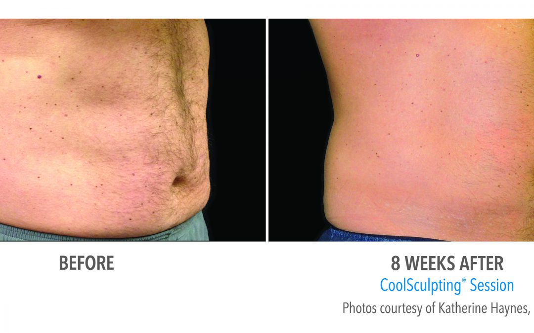 CoolSculpting: It’s For Men, Too
