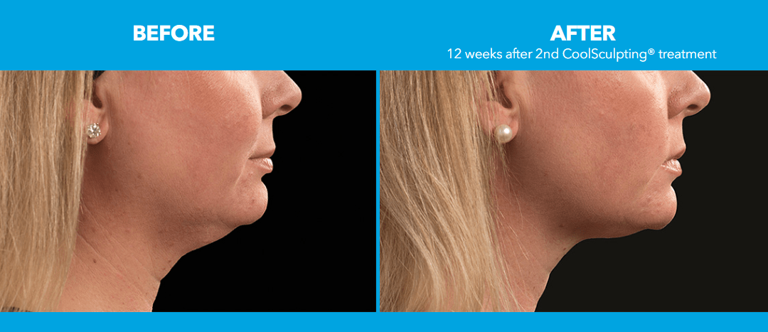Improving the Appearance of Lax Tissue: CoolSculpting For the Chin