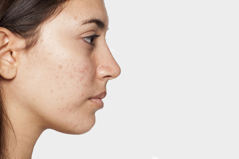 Acne Concerns and Treatments at Florida Aesthetics & Wellness